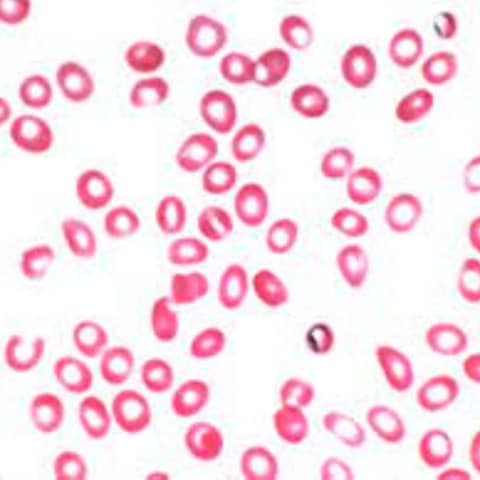 S3 E2: More Than You Ever Wanted to Know: Microcytic Hypochromic Anemia: The Christmas Episode