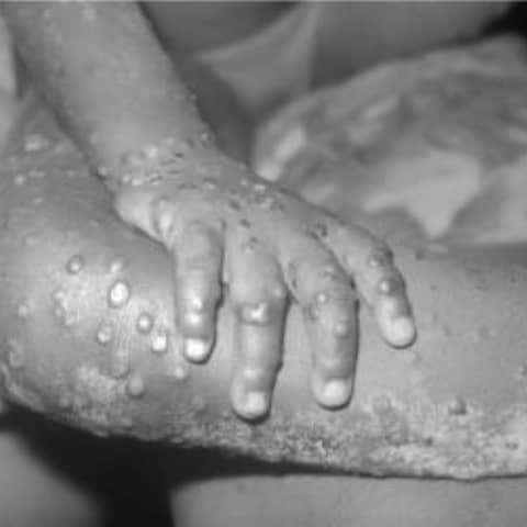 S3 E15: More Than You Ever Wanted to Know: Monkeypox: Q&A