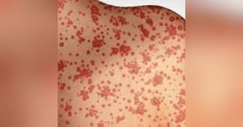 S3 E8: Minor Childhood Disease: The Story of Measles S3 E8: Minor Childhood Disease: The Story of Measles