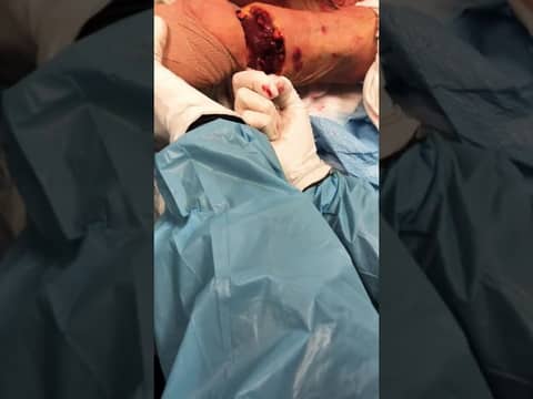 Learning how to do an emergency field amputation.