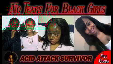 Best Friend Threw Acid In Her Face