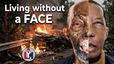 World's Oldest Full Face Transplant