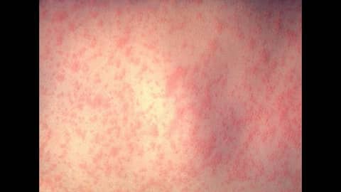 Why We Vaccinate Against Measles