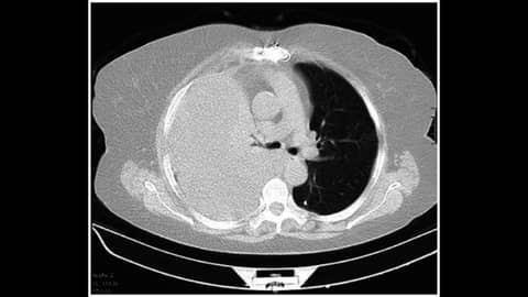 Journal Club: Small-bore vs Large-bore Chest Tube for Hemothorax