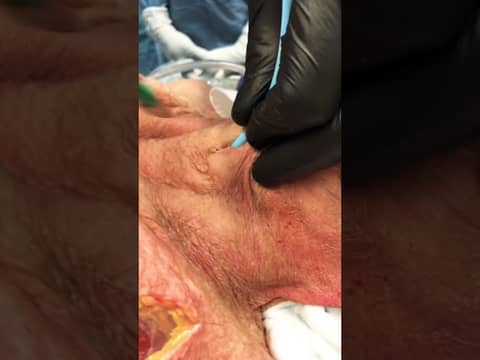 How to perform a surgical cricothyrotomy!