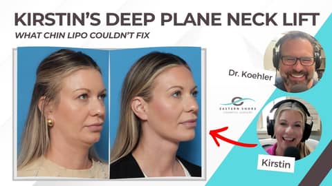 What Chin Lipo Couldn’t Fix: Kirstin’s Deep Plane Neck Lift