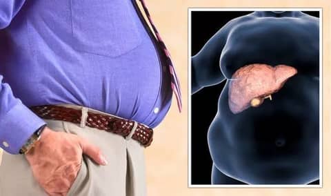 Rates of nonalcoholic fatty liver disease are soaring, study finds