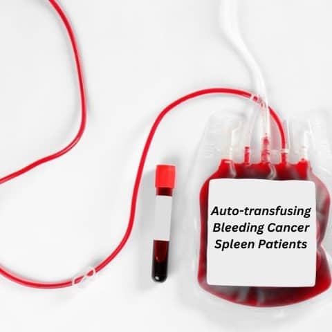 Autotransfusing Bleeding Cancer Spleen Patients
