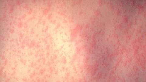 Why We Should Vaccinate Against Measles Why We Should Vaccinate Against Measles
