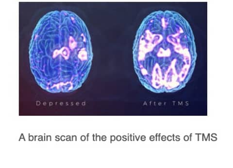 An Alternate Therapy For Depression An Alternate Therapy For Depression