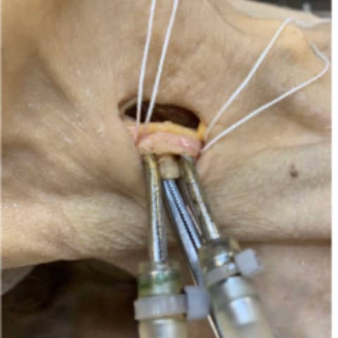 Susan Perry - The Embalming Process